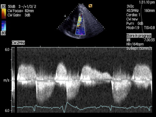CW Doppler signal in acute MR