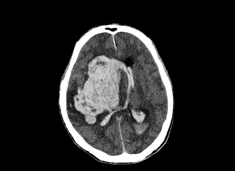 Image of Stroke.