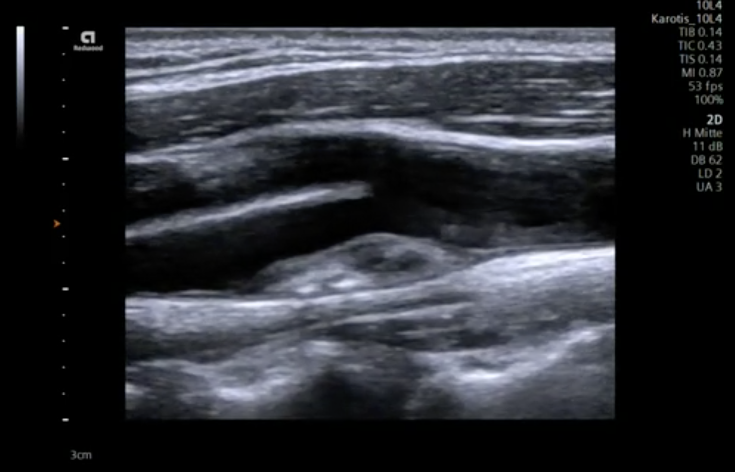 Carotid loop thumbnail.